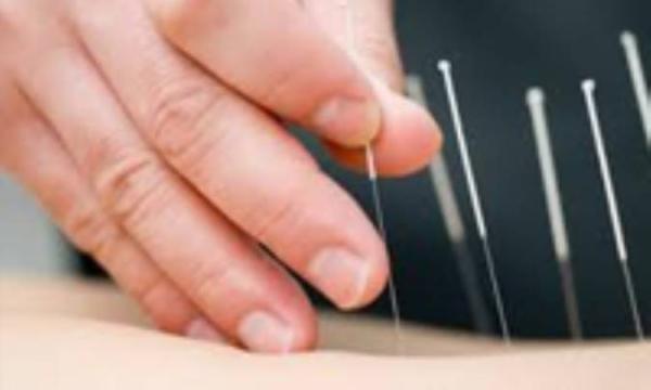 طب سوزنی برای تسکین افسردگی طب سوزنی برای تسکین افسردگی