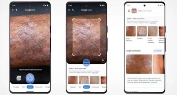 تشخیص بیماری های پوستی با گوگل لنز و هوش مصنوعی، عکس